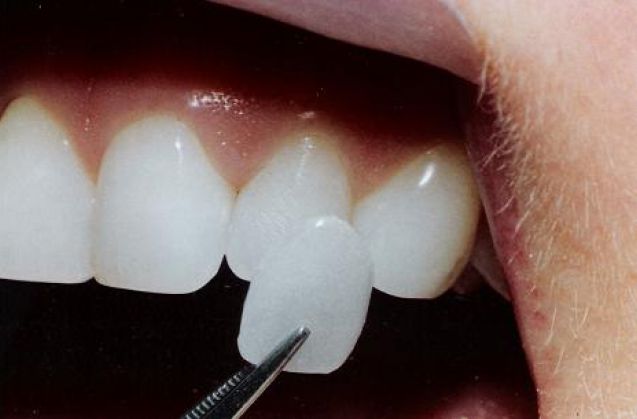 Problemi estetici ai denti? Esistono soluzioni piuttosto veloci